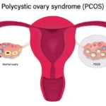 PCOS: Know About the Symptoms, Treatments, and Weight Management – Your Proper Guide to Managing Polycystic Ovary Syndrome
