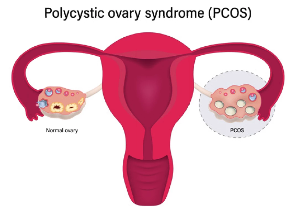 polycystic ovary syndrome - pcos