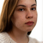 All You Should Know About Hyperpigmentation And Melasma