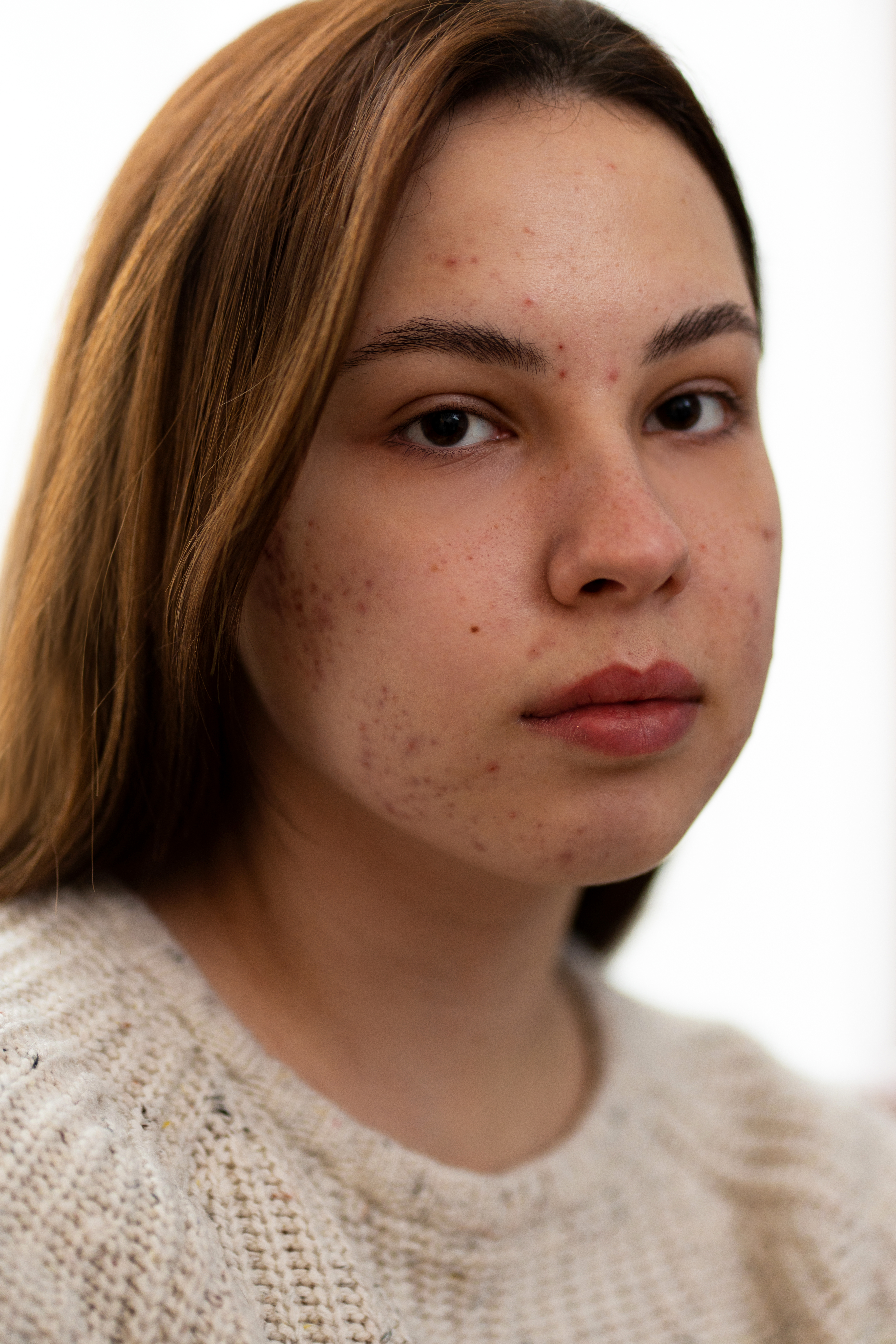 All You Should Know About Hyperpigmentation And Melasma