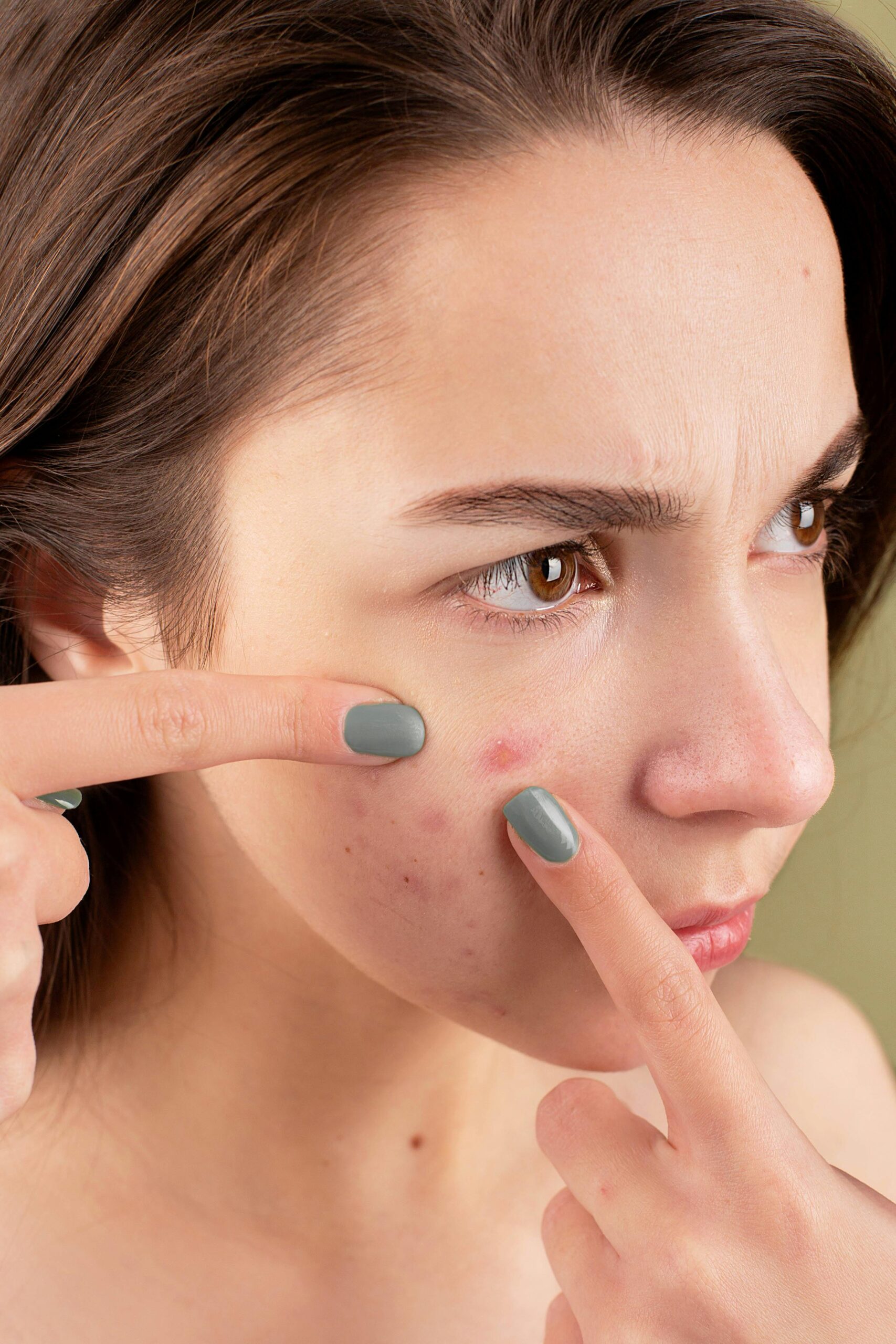 The A to Z of Acne: A Comprehensive Guide For A Zit-Free Life