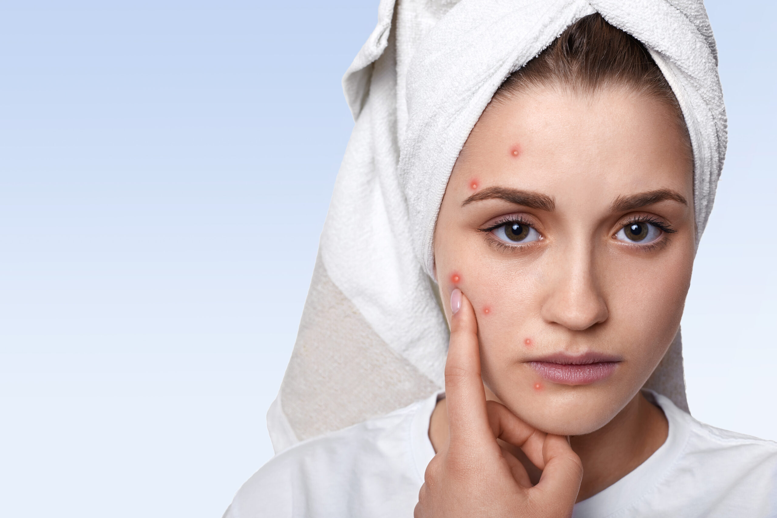 Hormonal Acne – Causes and Treatment: Understanding the Basics and How to Manage It