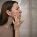 Rosacea – All You Need To Know