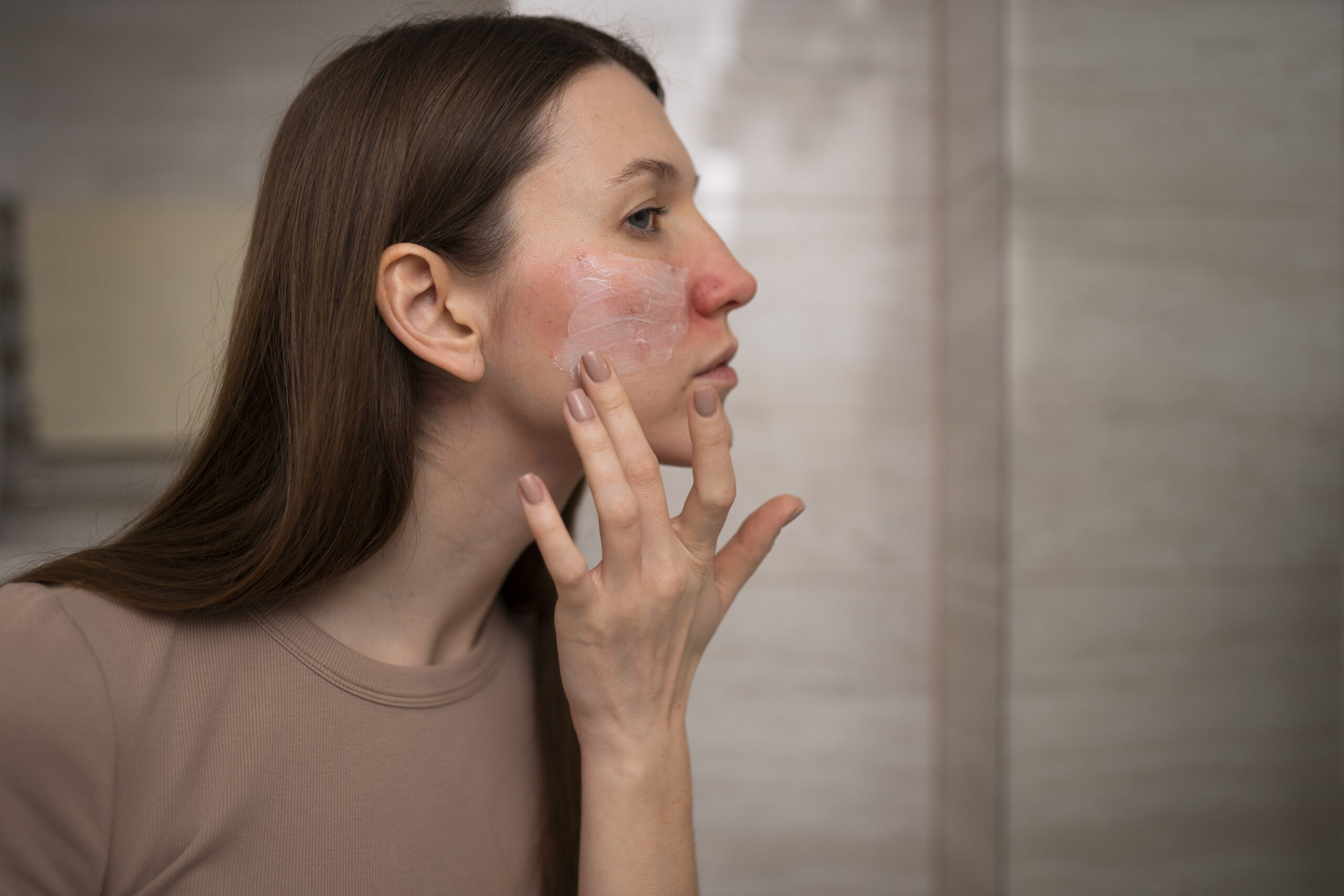 Rosacea – All You Need To Know