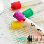 Epstein-Barr Virus (EBV) Reactivation: Symptoms, Treatment, Care