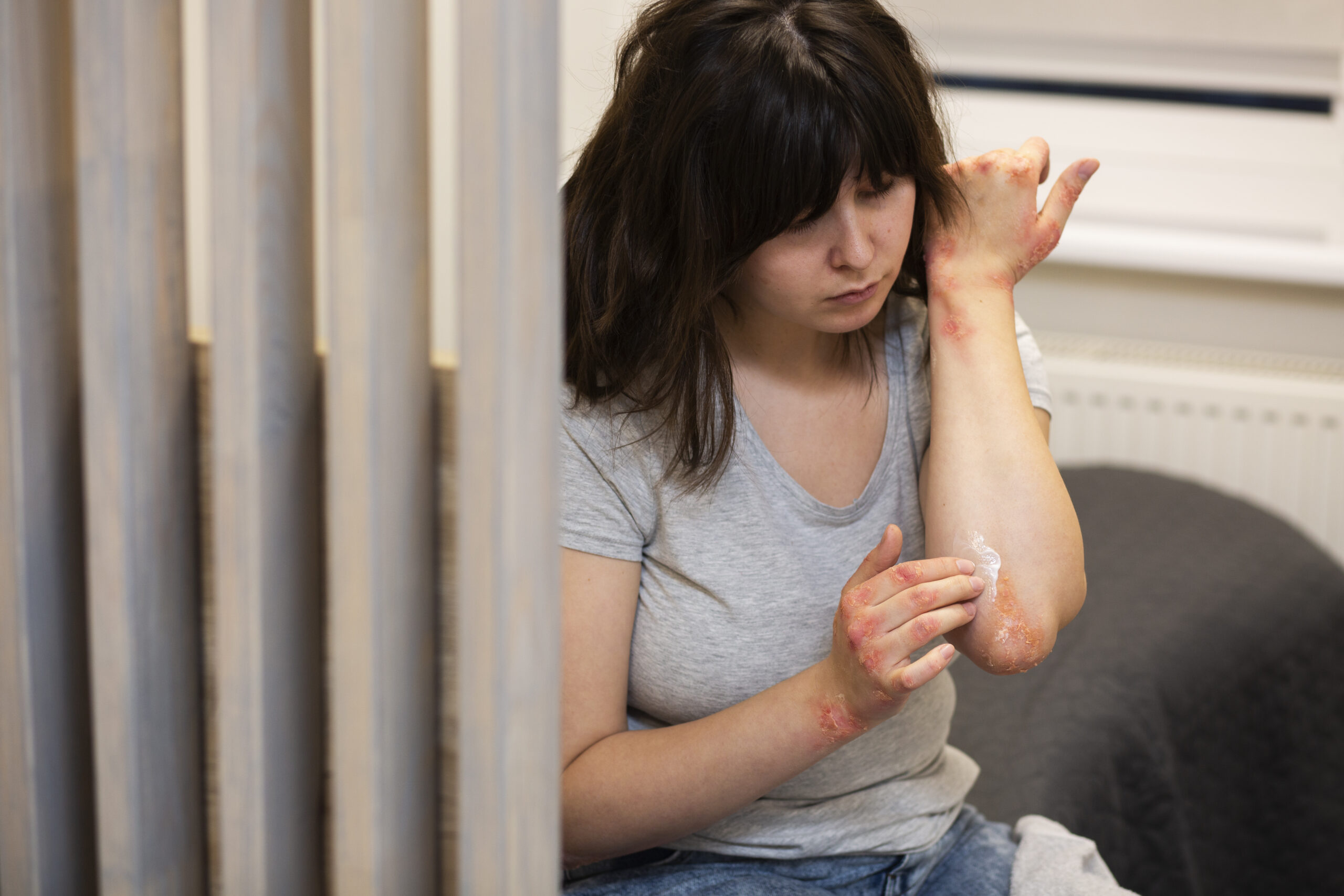 Psoriasis and Psoriatic Arthritis: Symptoms, Treatment, and Relief