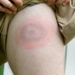 Chronic Lyme Disease – What We Know Now