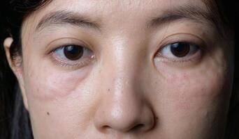 Myasthenia Gravis: Symptoms, Treatment, and Management