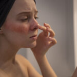 Lichen Planus – Oral, Genital and Skin Presentations