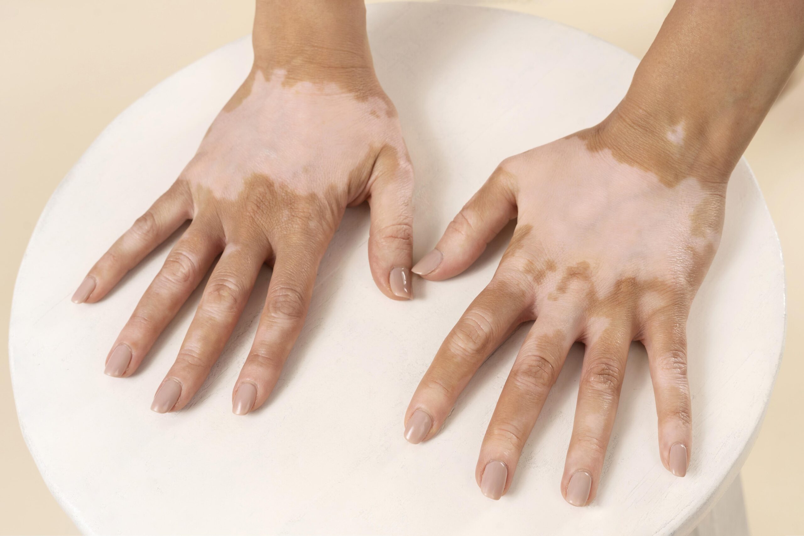 Vitiligo – Autoimmunity and Treatment Options